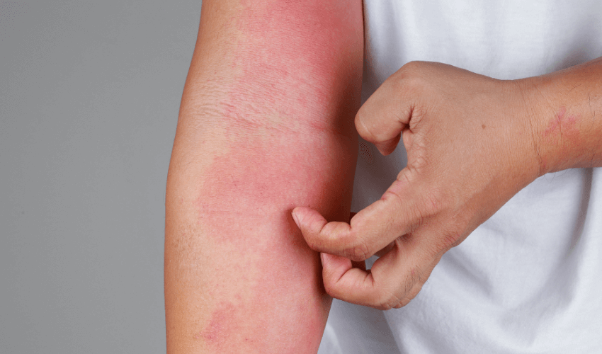 Can An Intolerance Test Help my Eczema?